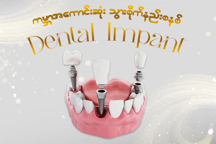 Dental Implant