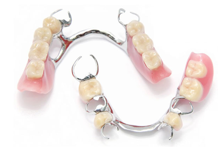 သတ္တု သွားအံကပ်လုပ်ခြင်း ( Metallic Denture )