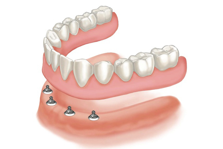 ရိုးရိုးသွားအံကပ်ပြုလုပ်ခြင်း ( Acrylic Denture )