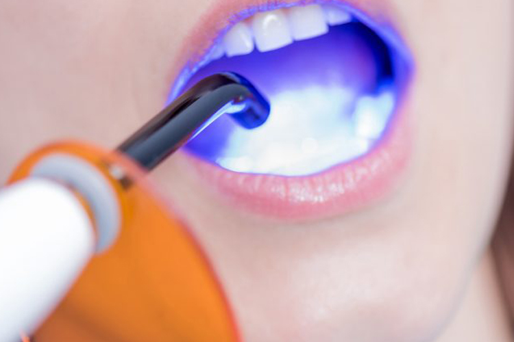 Light shop cure filling