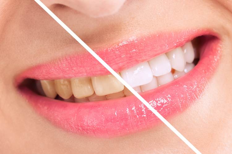 Teeth whitening laser bangkok