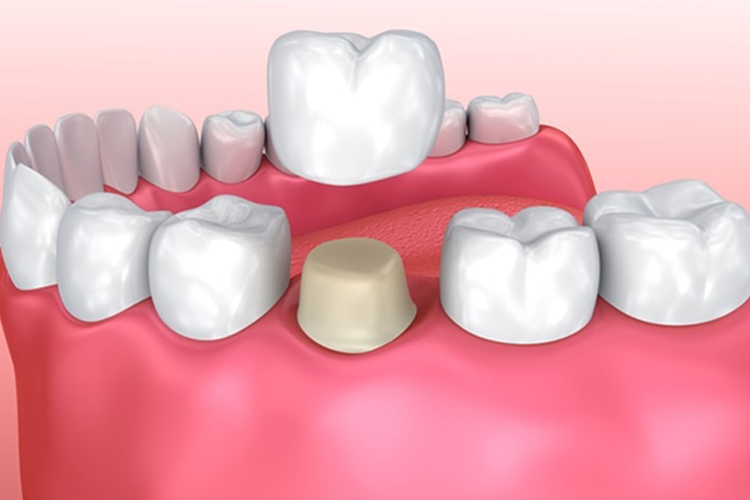 သွားအစွပ် စွပ်ခြင်း ( Tooth Crown ) 