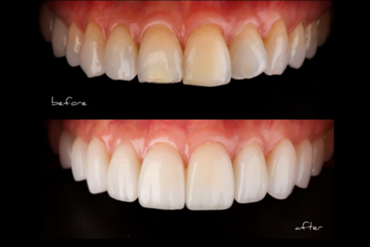 Dental Veneer