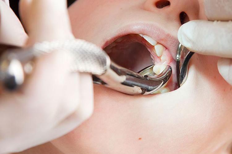 သွားနှုတ်ခြင်း ( Tooth Extraction )