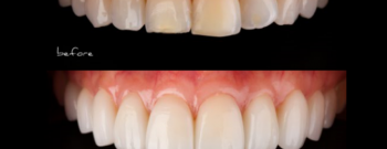 Dental Veneer