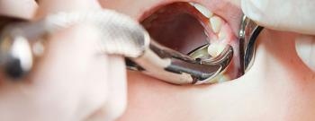 သွားနှုတ်ခြင်း ( Tooth Extraction )
